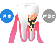 歯周病は恐ろしい病気です