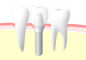 インプラント