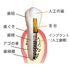 インプラントとは？